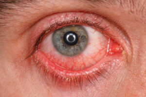 conjuntivitis-1-scaled